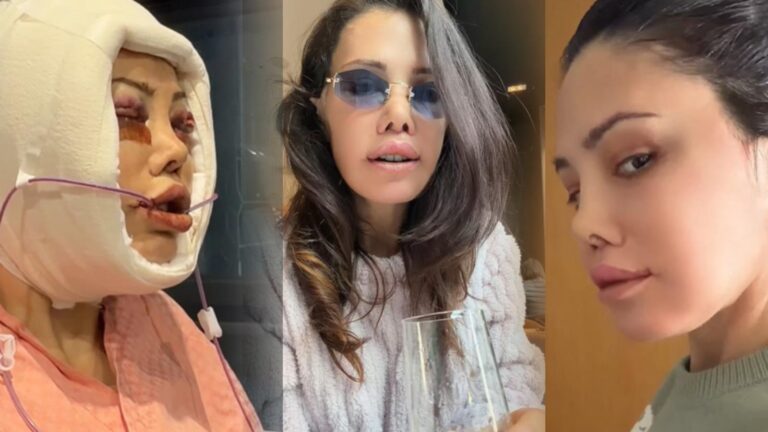 Yüz naklinin ardından revizyon ameliyatı olmuştu! Didem Ceran son haliyle yine gündemde